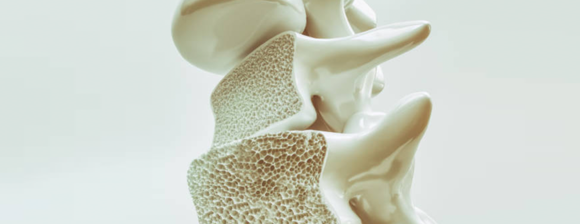 medical research osteoporosi Roma