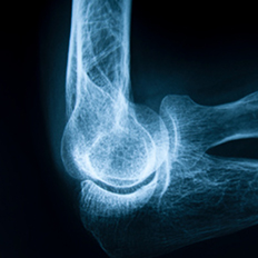 Pacchetto Osteoporosi medical research roma